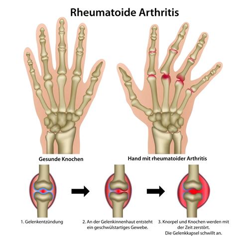 Understanding the Different Types of Rheumatoid Arthritis