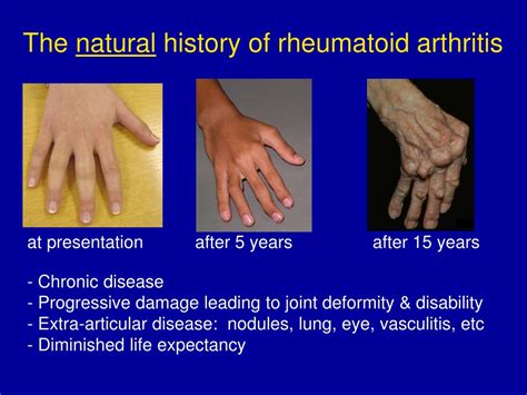 Understanding the Onset Age and Initial Signs of Rheumatoid Arthritis
