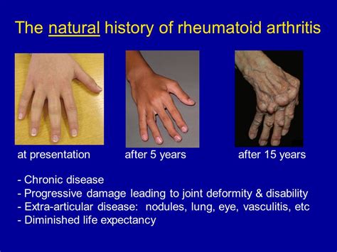Understanding the Progression of Rheumatoid Arthritis: Stages and Symptoms