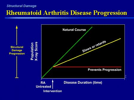Understanding the Stages and Progression of Rheumatoid Arthritis