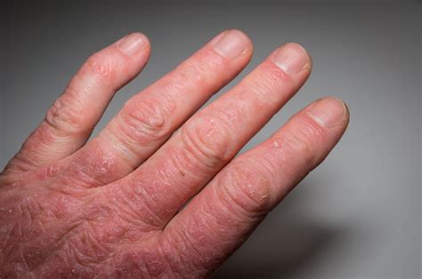 Rheumatoid Arthritis Symptoms and Causes